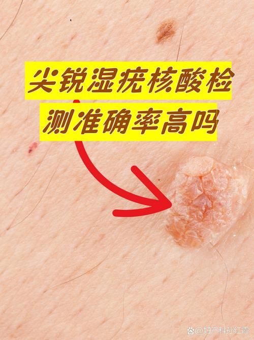 山东省济南市章丘区新增20例核酸阳性及29例无症状/章丘确诊一例新型冠状病毒