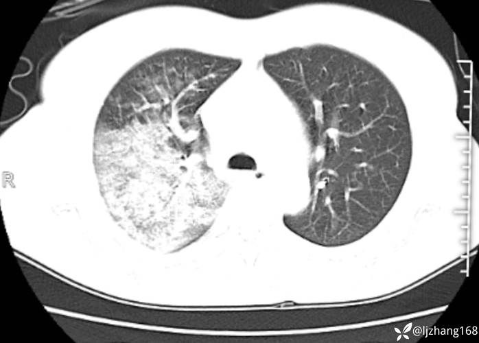  纳雍县现有无症状感染者6例:纳雍出现新型肺炎