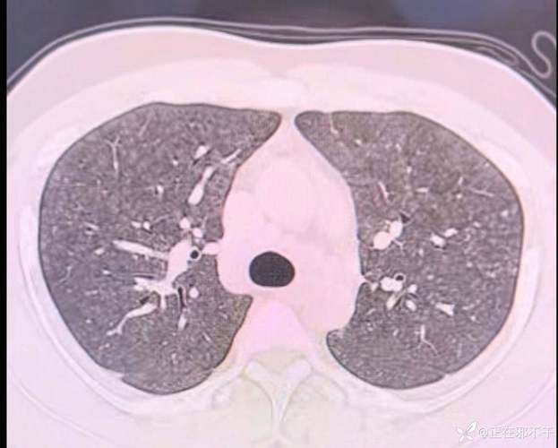 全球新增境外输入3例芝罘区19例:全球新增肺炎病例