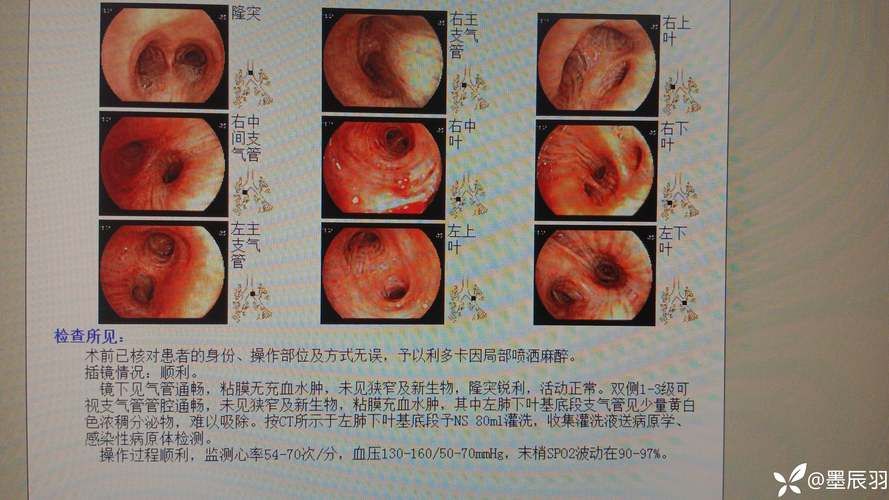 【内蒙古自治区鄂尔多斯市近3天死亡病例曲线图表,鄂尔多斯感染事件】