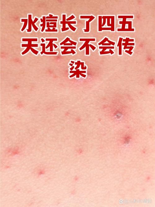 湖北随州广水现有无症状感染者13例/湖北随州广水市