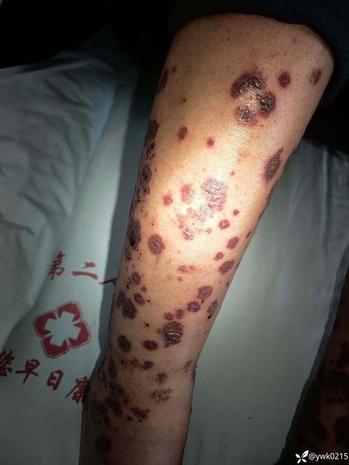  湖南省湘潭市岳塘区通报4例阳性感染者详情:湖南省湘潭市岳塘区有变