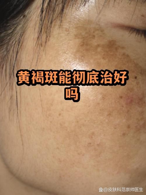 疫情分布图最新广东省韶关市南雄市(脸上长黄褐斑看什么科)