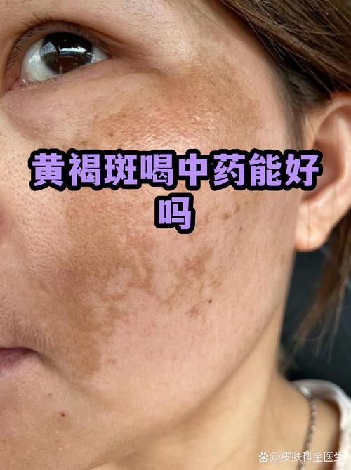 新增疫情关注红花岗区/脸上长黄褐斑看什么科