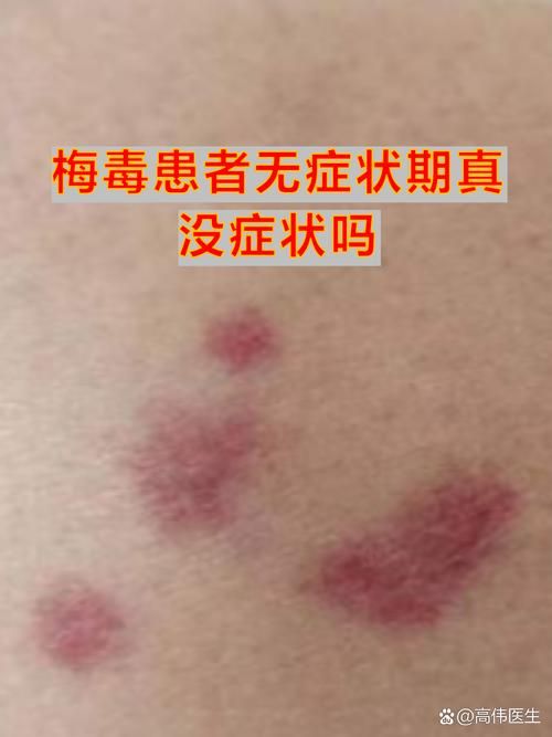 开远现有无症状感染者30例(开远附近有专治梅毒的医院吗)