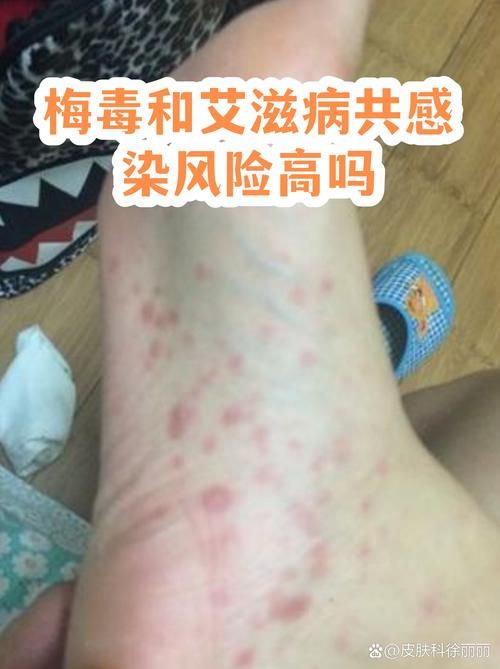 疫情防控中风险地区霍山县(霍山县2026年艾滋病)