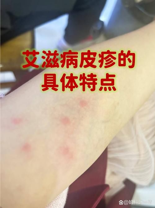 吉林省现有无症状感染者24例:吉林省有多少艾滋病感染者